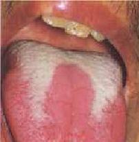 Saburra de la lengua parcial