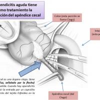 Síntomas de apendicitis