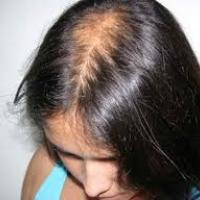 Alopecia femenina