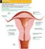 Endometriosis - Tratamientos de Medicina Natural