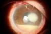 Síntomas de la úlcera corneal