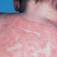 Medicina natural para la dermatitis atópica